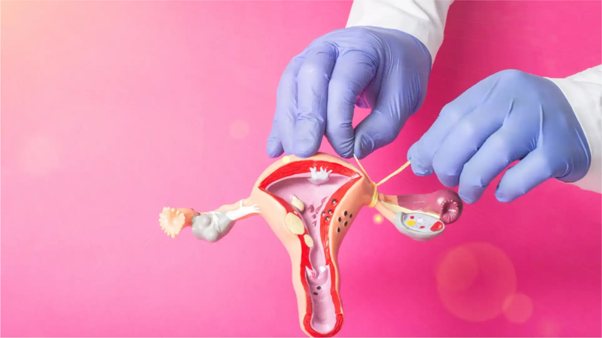 ¿Qué es la ligadura de trompas por laparoscopia y que porcentaje de éxito tiene?