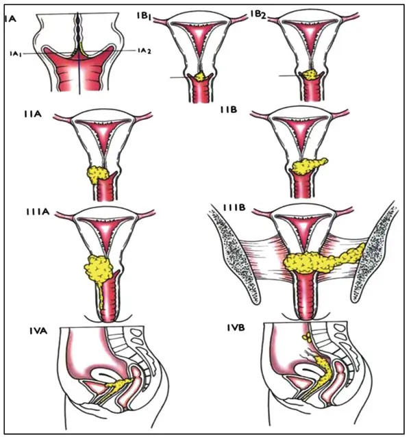 ¿Cómo puedo saber si tengo cáncer de cuello uterino? 4 cáncer de cuello uterino Cuáles son las etapas del cáncer de cuello uterino