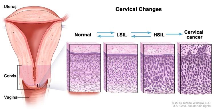 ¿Cómo puedo saber si tengo cáncer de cuello uterino? 1 cáncer de cuello uterino ¿Qué es el cáncer de cuello uterino y qué tipos existen