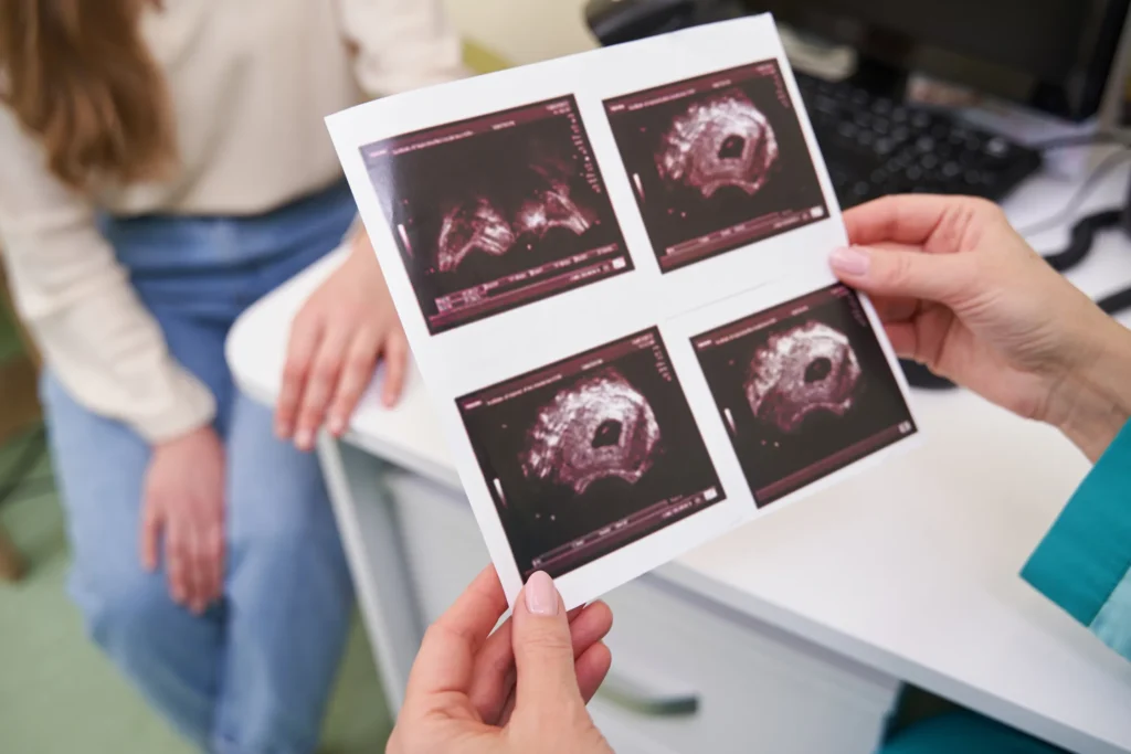 Ecografía ovárica mostrando síndrome de ovario poliquístico